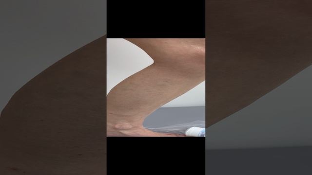 Варикоз на ноге у девушки. Как лечить варикоз? Лечение варикоза. Флеболог. Флеболог Москва смотреть онлайн