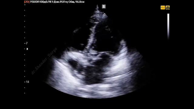 Дополнительное образование на правой коронарной створке аортального клапана. Вегетация на АК?
