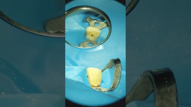 12 - внутрикоронковая резорбция смотреть онлайн