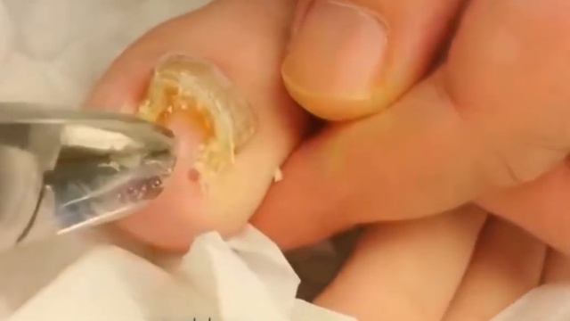 Грибок на ногтях. Жутко. смотреть онлайн