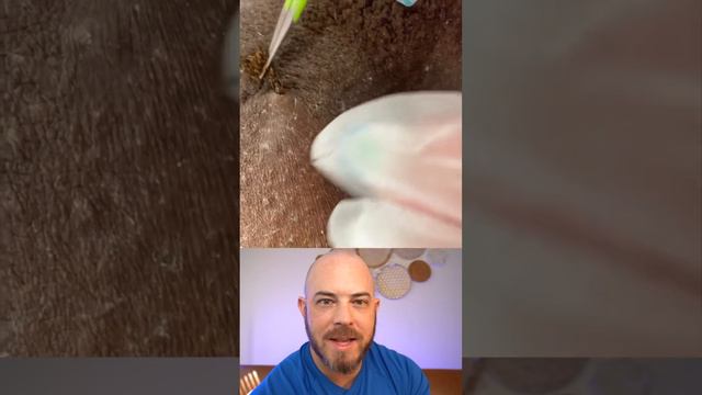 Derm reacts to INSANE ingrown hair extraction! #dermreacts #doctorreacts #ingrownhair смотреть онлайн