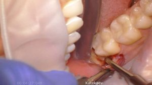 Удаление дистопированного зуба мудрости