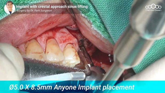 Implant placement with Crestal approach sinus lifting [Live surgery - Dr. Park Sungwon] смотреть онлайн