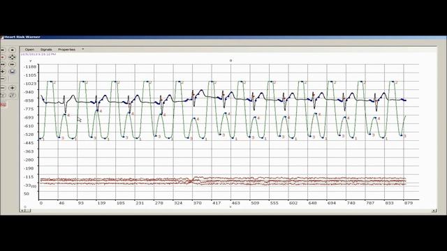 Ppg Ecg/ekg signal feature extraction смотреть онлайн