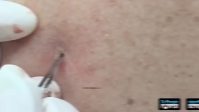 Dr. Pimple Poppers 8 WORST Blackhead Removals - You're not going to want to eat while you watch thi смотреть онлайн