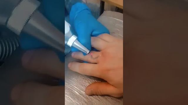 Лазерное удаление татуировок и перманентного макияжа смотреть онлайн