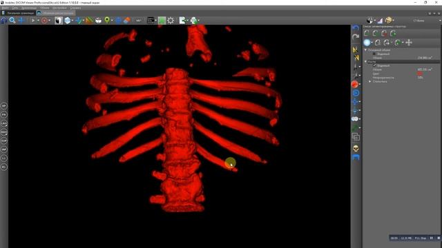 Manual 3D rib cage bones segmentation смотреть онлайн