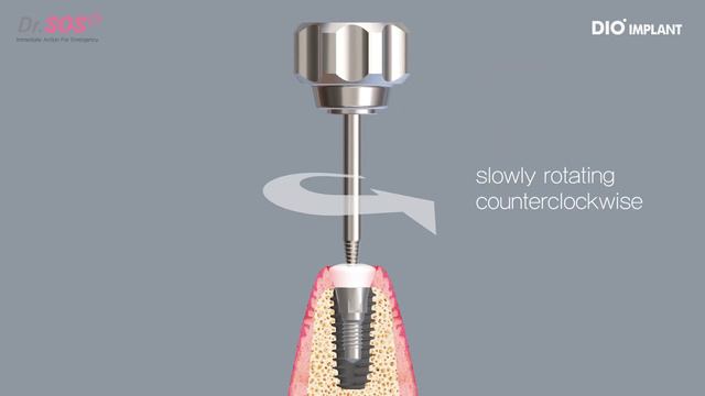 Removing the abutment with distorted Hex connection смотреть онлайн