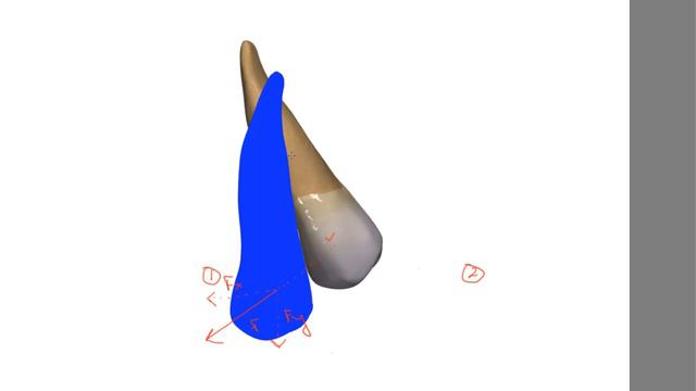 Orthodontic movement with aligner attachment. A theoretical concept. смотреть онлайн
