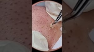 Выдавливание прыщей