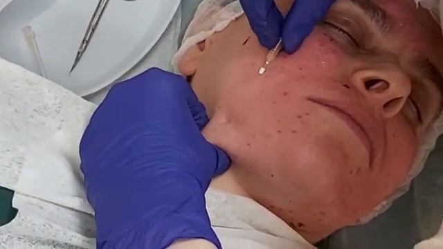 АирисКом студенты учатся: коррекция морщин нижней части лица. Мезонити Cog.