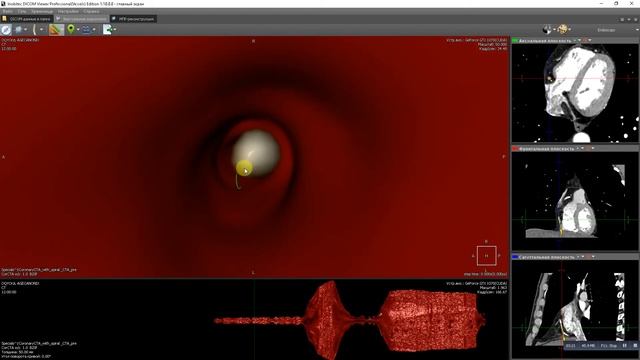 Coronary artery endoscopy смотреть онлайн