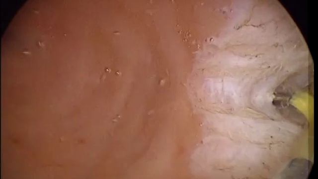 Learn And Love Hysteroscopy ;Uterine Septum Metroplasty By Shawki,JR