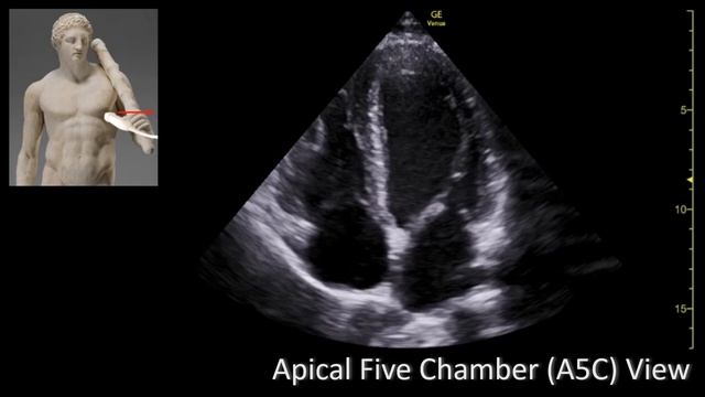Apical Five Chamber View (A5C). Perioperative & Critical Care ECHO/ POCUS смотреть онлайн