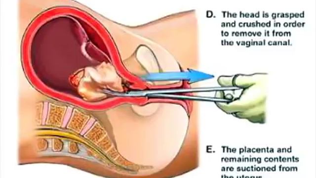 Illustrated abortion procedure!! What REALLY happens at the abortion clinic!!! смотреть онлайн