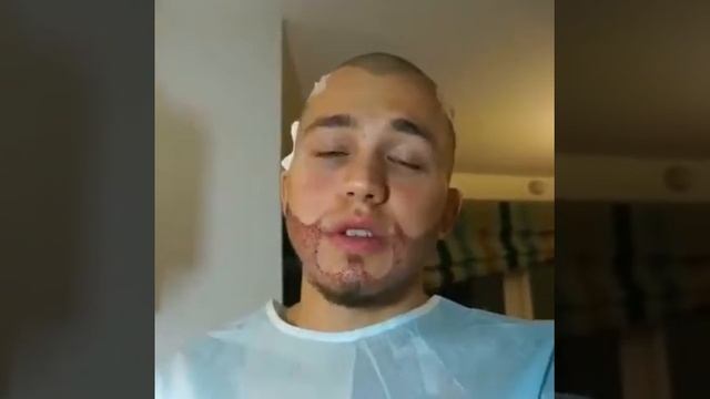 Врачи пересадили ему бороду