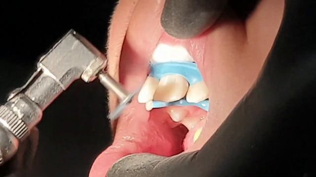 Наращивание зубов детям смотреть онлайн