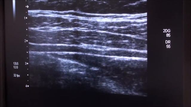 TAP-block Ultrasound смотреть онлайн