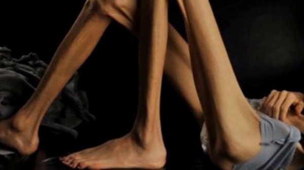 Анорексия / Anorexia