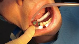 Примеряем и фиксируем коронки из диоксида циркония. Протокол фиксации на NX3.