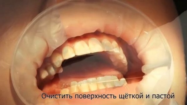 Самое лучшее восстановление эмали без сверления InnoDent Инструкция.mp4
