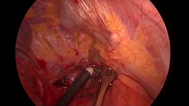 Asvide: Right paratracheal lymphadenectomy. The video shows a radical lymph node dissection... смотреть онлайн