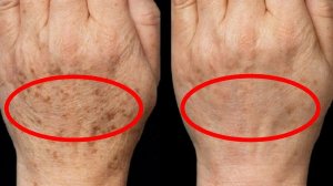 Удаляем  пигментные пятнышки на поверхности кожи рук в домашних условиях навсегда!