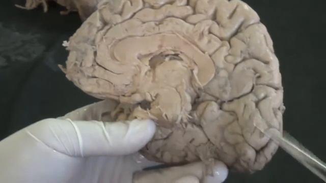 ◄╣ Brain (Cerebral Cortex) - Another Specimen ╠► смотреть онлайн