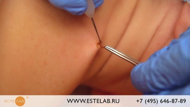 Удаление папиллом в «ЭСТЕЛАБ»