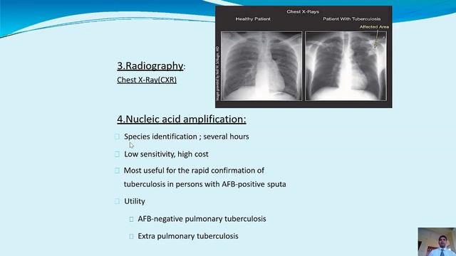 TUBERCULOSIS -WHO PREVENTION PROTOCOL 2019, MODE OF TRANSMISSION, SYMPTOMS, DIAGNOSIS,PREVENTION . смотреть онлайн