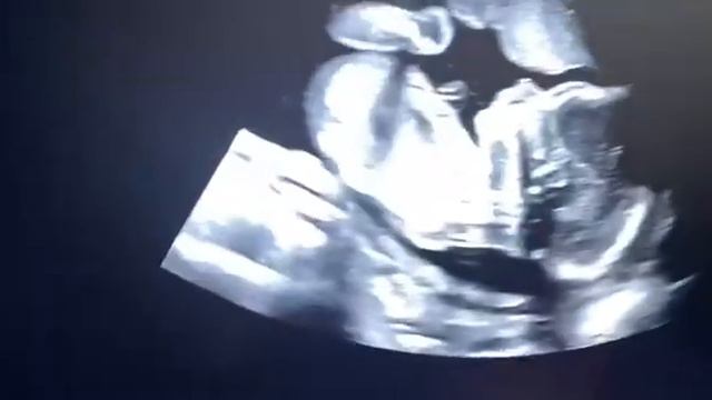 Узи 19 недель и 3 дня Галиева Алсу смотреть онлайн