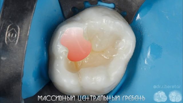 DIRECT RESTORATION. SECOND MOLAR OF UPPER JAW. смотреть онлайн