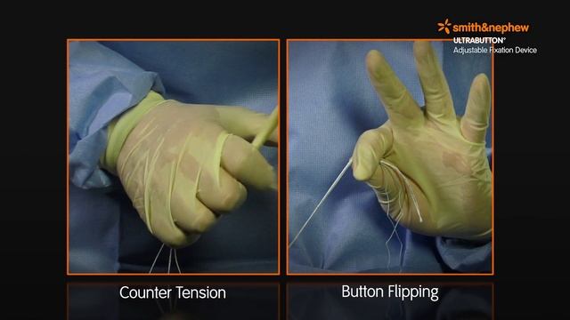 ULTRABUTTON* Device and BIOSURE* REGENESORB Screw for ACL Reconstruction with a Hamstring Graft смотреть онлайн