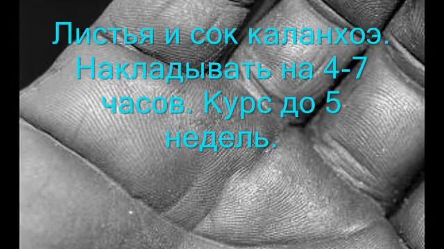 Бородавки. Удаление бородавок. Народные рецепты.(Часть 2.) смотреть онлайн