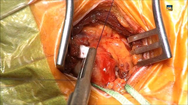 Right Axillary Artery Cannulation: Seldinger Technique смотреть онлайн