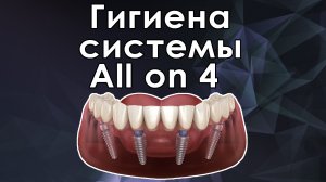 Чистка конструкции all on 4