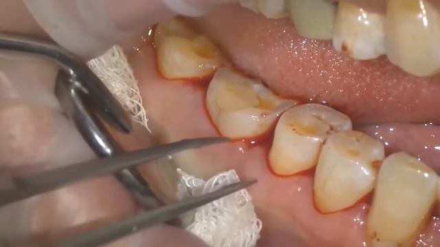 M-Chip наноматрица как правильно устанавливать. www.apexdental.ru смотреть онлайн