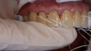 Установка несъемного протеза из диоксида циркония. Протезирование зубов