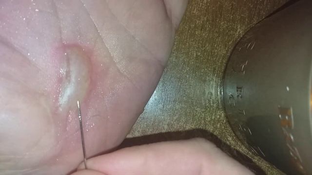 Прокалывание волдыря от ожога. смотреть онлайн