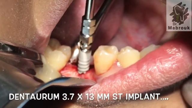 Dentaurum Implant смотреть онлайн