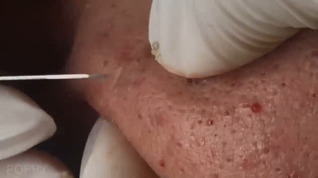 Blackheads Removal -  Best Pimple Popping Videos