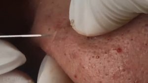 Blackheads Removal -  Best Pimple Popping Videos