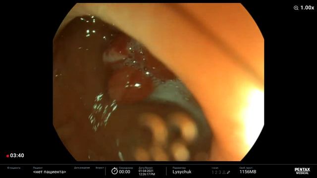 Stomach cancer/ Рак желудка смотреть онлайн
