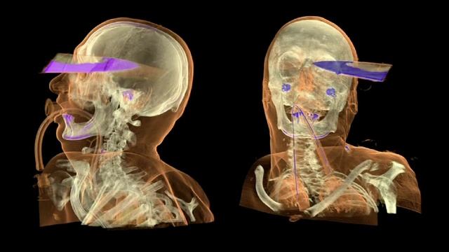 Anders Ynnerman: Visualizing the medical data explosion смотреть онлайн