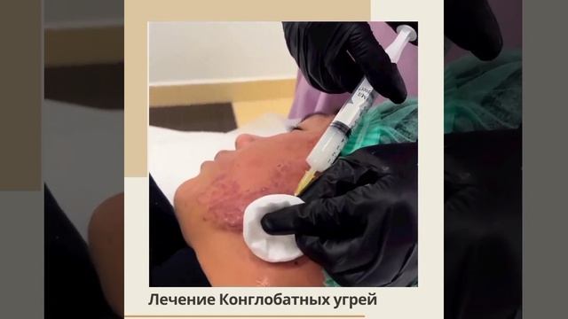 Конглобатные угри прыщи, акне — это тяжелая форма угревой болезни, при которой крупные угревые шаро