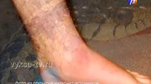 Про укусы ядовитых змей. смотреть онлайн