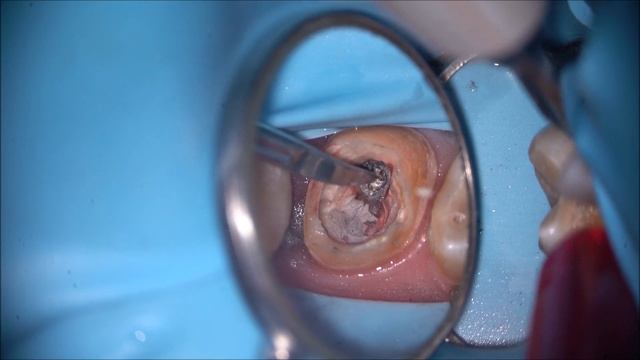 Извлечение культевой вкладки. смотреть онлайн