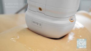 Age control: результат за 1 процедуру система стройности Липосоникс и подтяжка лица СМАС (SMAS Hifu