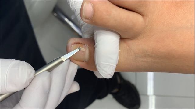 The Worst  Toenail  On Earth!  “Thorn
