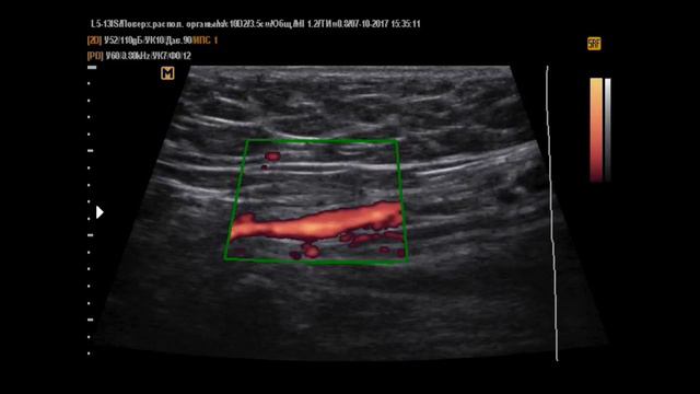 Фуникулоцеле 2 (7-10-17)